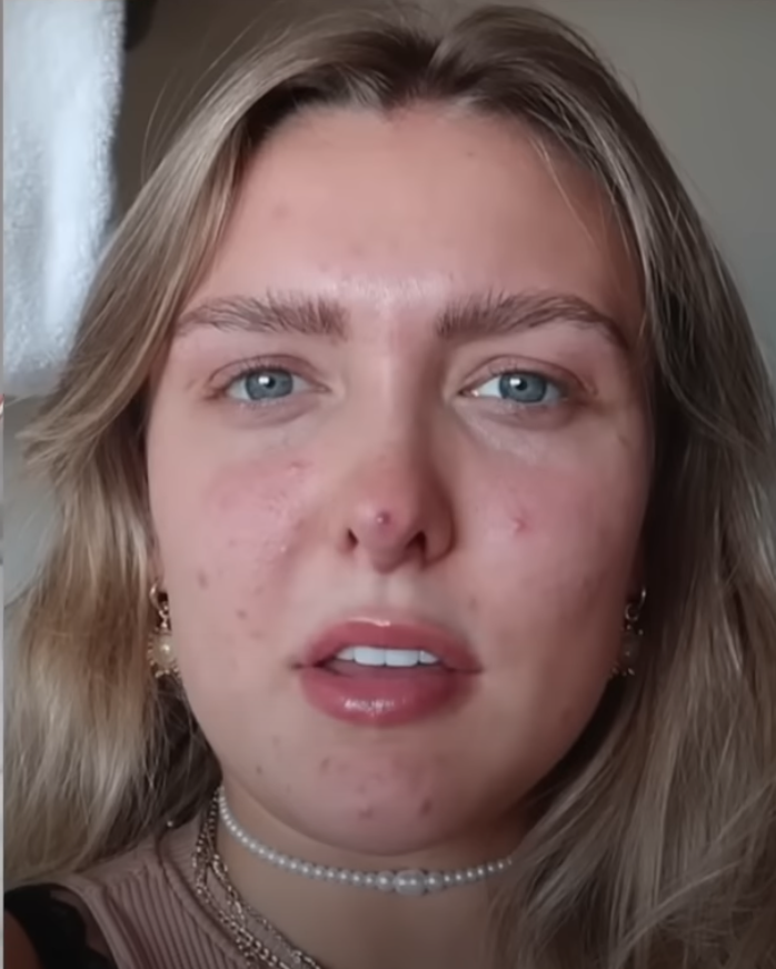 influencer-gets-“threadlift-nose-job,”-says-things-didn’t-go-as-planned