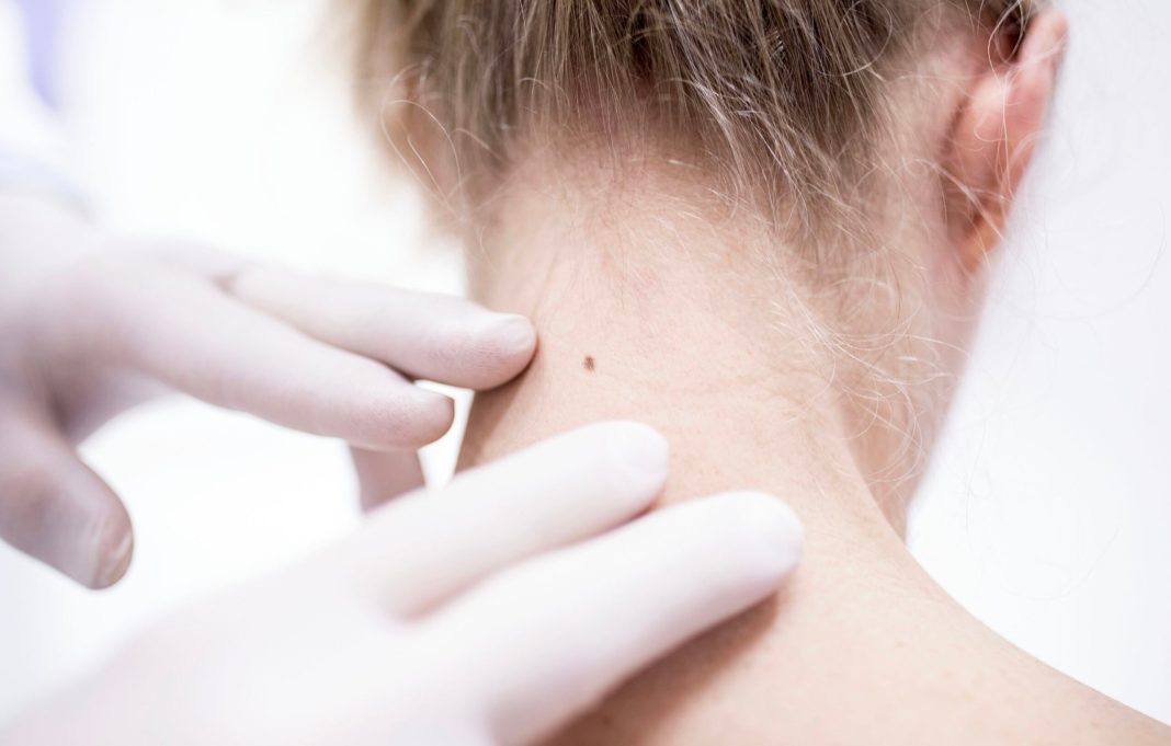 non-melanoma-skin-cancers-a-global-health-risk,-study-finds