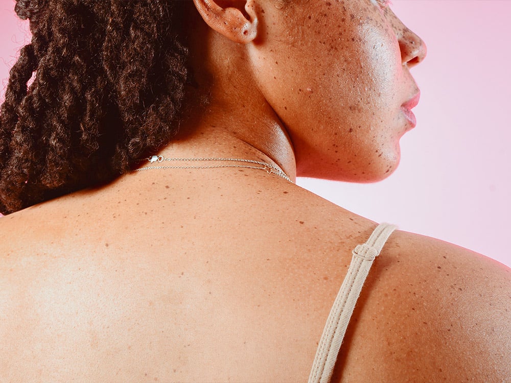 back-acne-scars:-expert-approved-ways-to-get-a-smoother-back